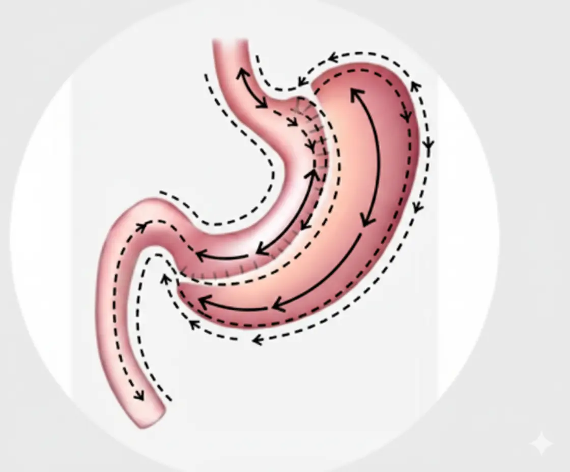Opération de Sleeve gastrectomie en Tunisie pour le traitement de l'obésité